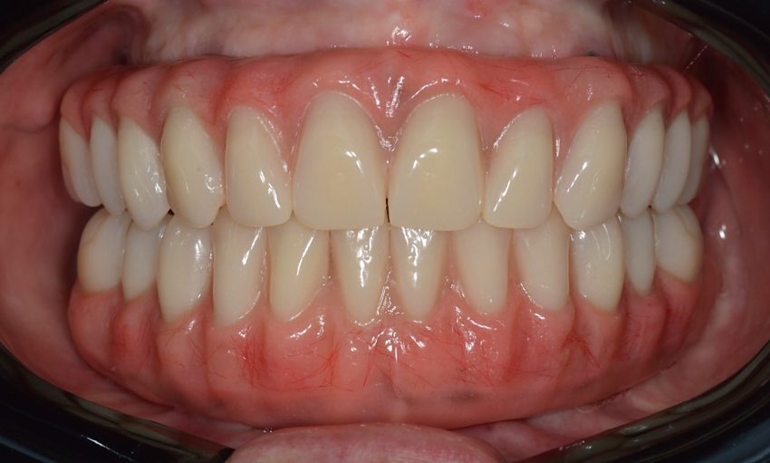 implantes-dentarios-e1781375140859